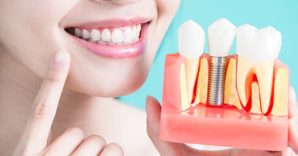O que são implantes dentários? Como funcionam?